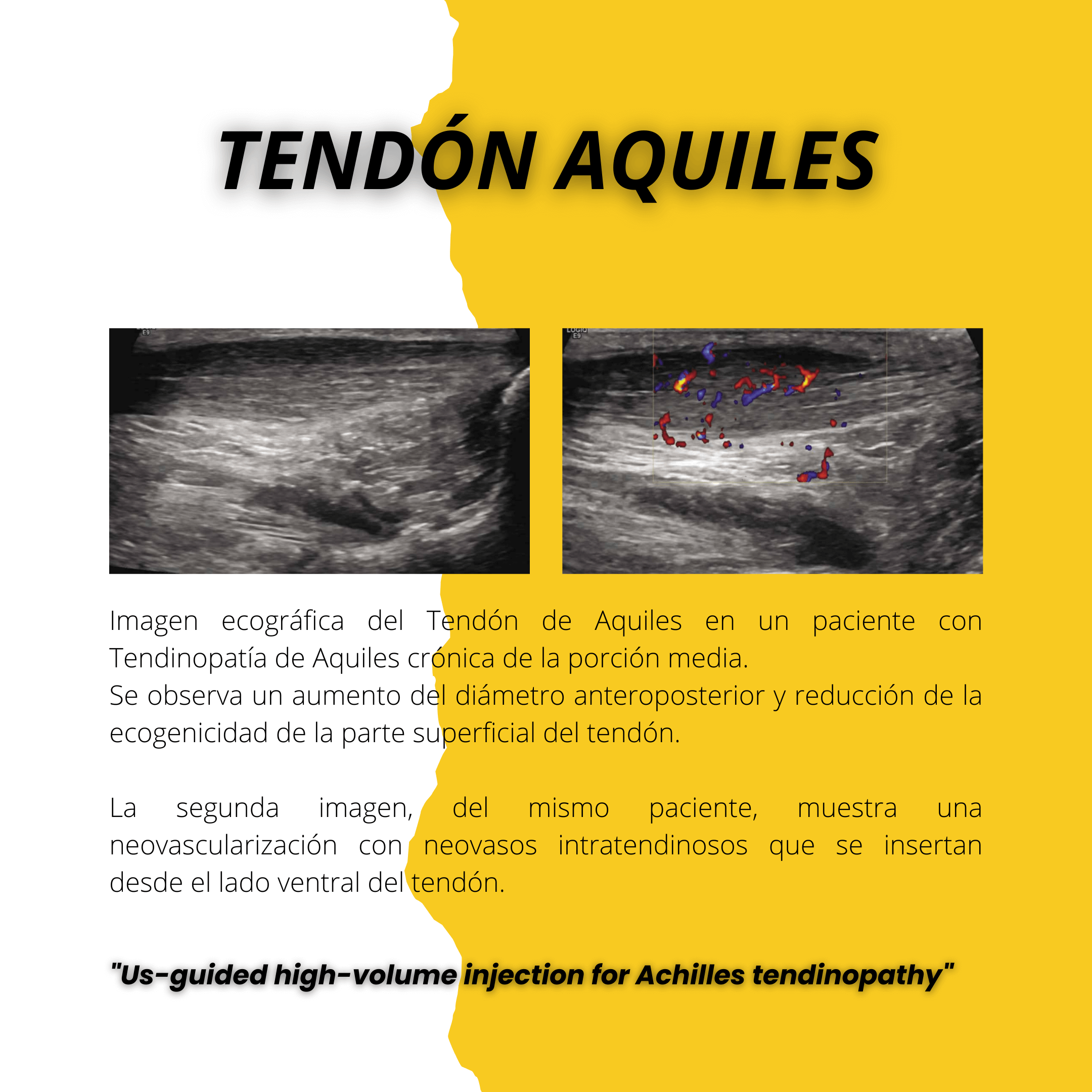 Tendon de Aquiles tempo formacion region tobillo.png